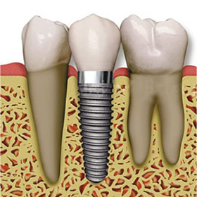 img-implant