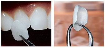 img-veneers