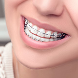 Clarity™ Clear Braces